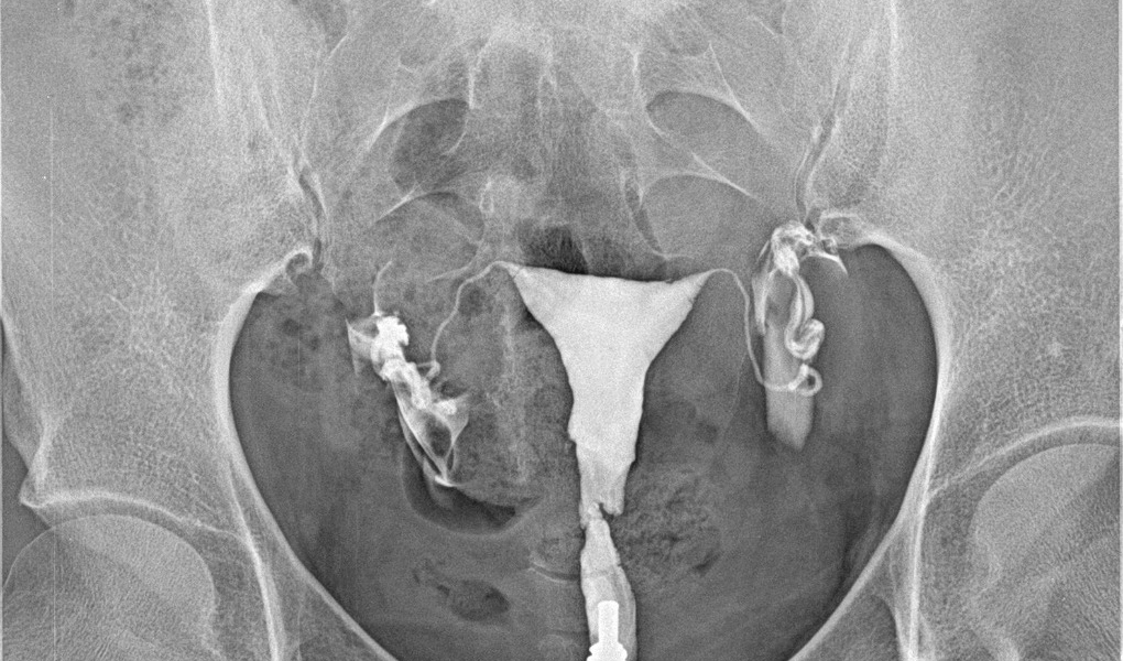 Histerossalpingografia